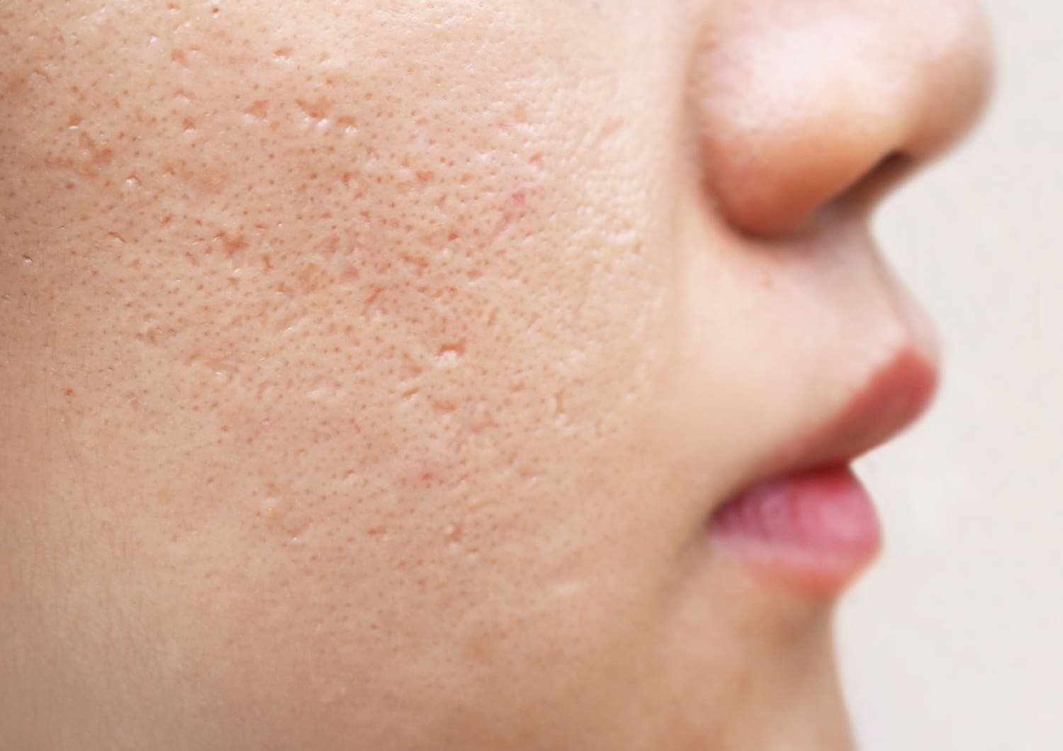 Acne Scarring — Woodside Skin Clinic