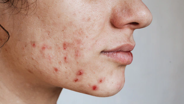 Acne — Woodside Skin Clinic