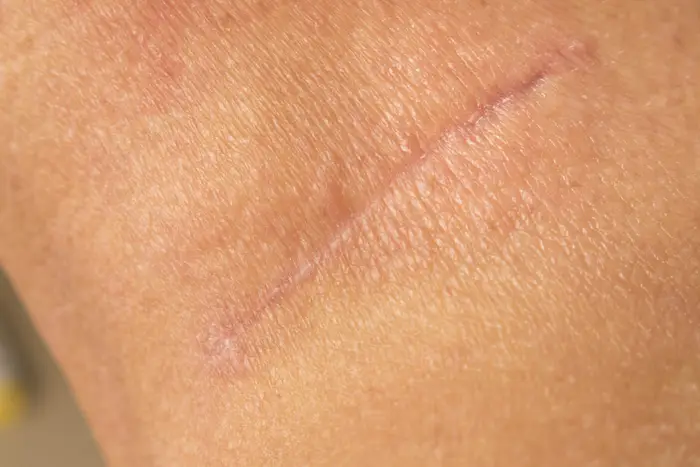 Body Scars — Woodside Skin Clinic