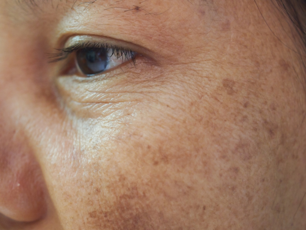 Age Spots — Woodside Skin Clinic
