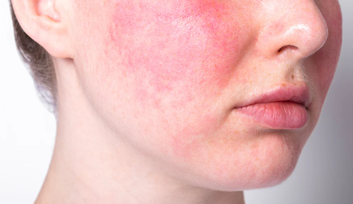 Rosacea — Woodside Skin Clinic
