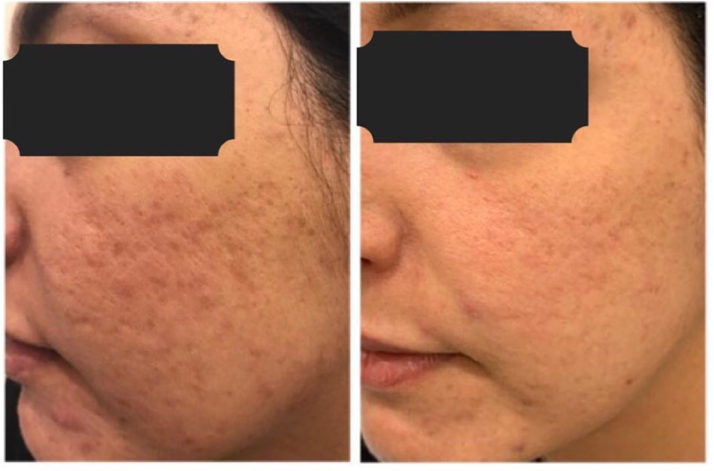 Acne — before and after NeoGen treatment