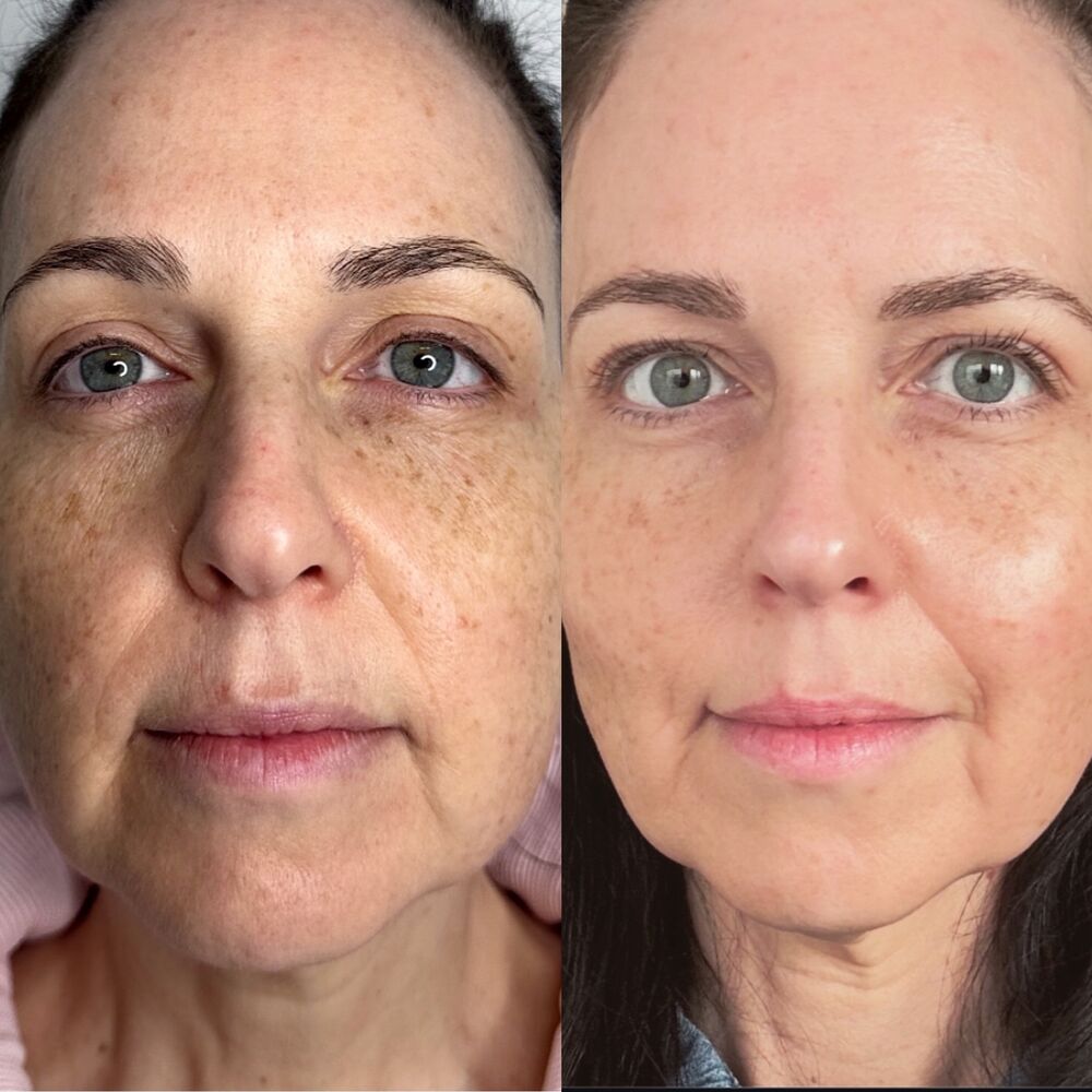 Pigmentation — before and after NeoGen treatment