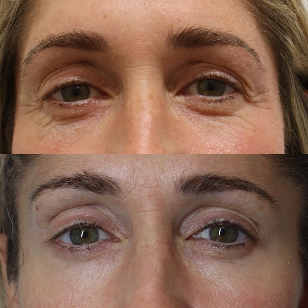 Skin rejuvenation, eyes — before and after NeoGen treatment