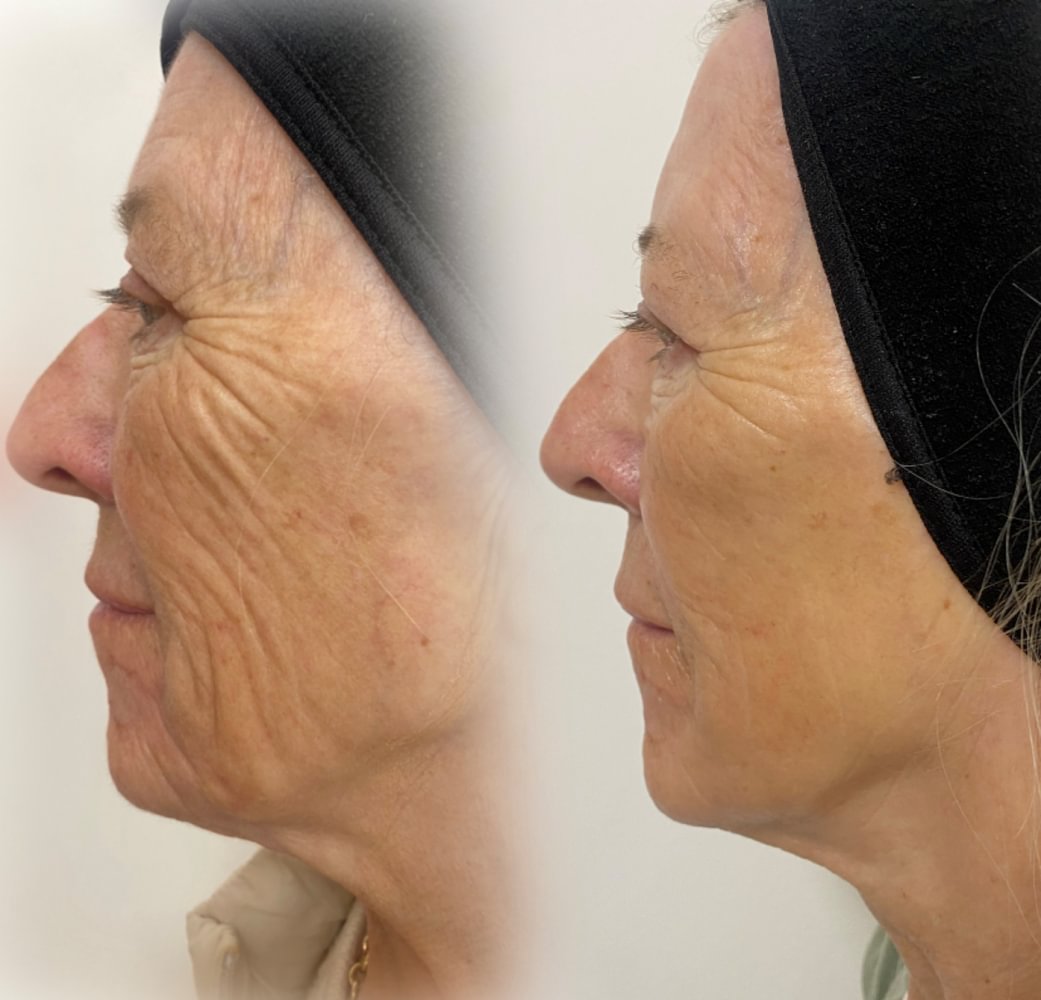 Skin rejuvenation, jowls — before and after NeoGen treatment