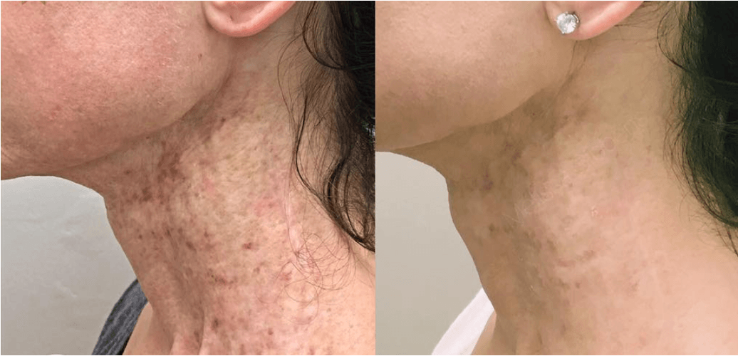 Scars — before and after NeoGen treatment