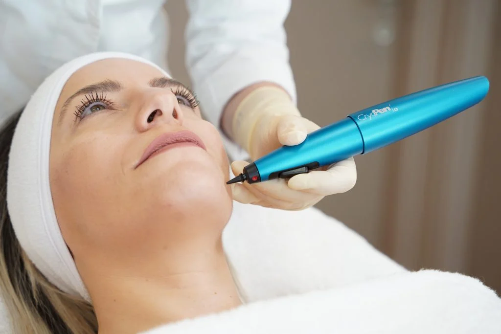 Cryotherapy treatment — Woodside Skin Clinic