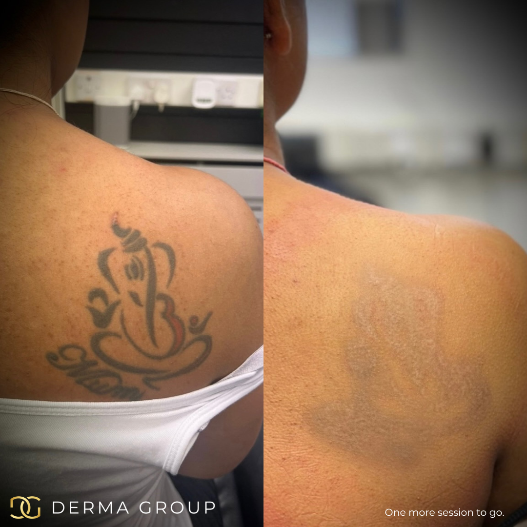 Laser Tattoo & SPMU Removal — Woodside Skin Clinic