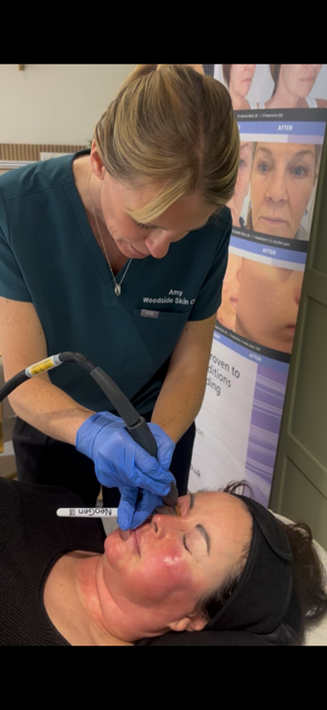 NeoGen treatment in clinic — Woodside Skin Clinic