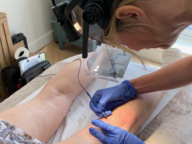 Thermavein treatment — Woodside Skin Clinic